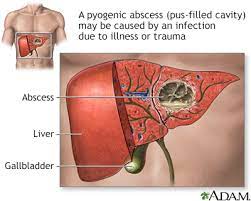 Liver abscess