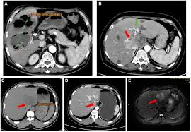 Liver abscess